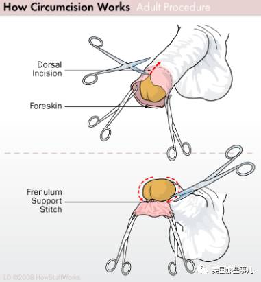 包茎手术套环流程图图片